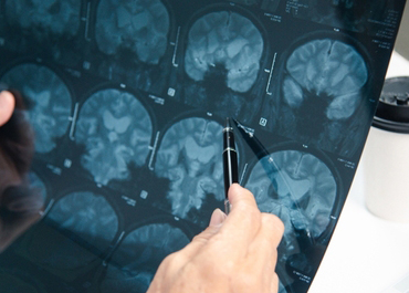 Doctor pointing to areas of a brain scan (MRI or X-ray).
